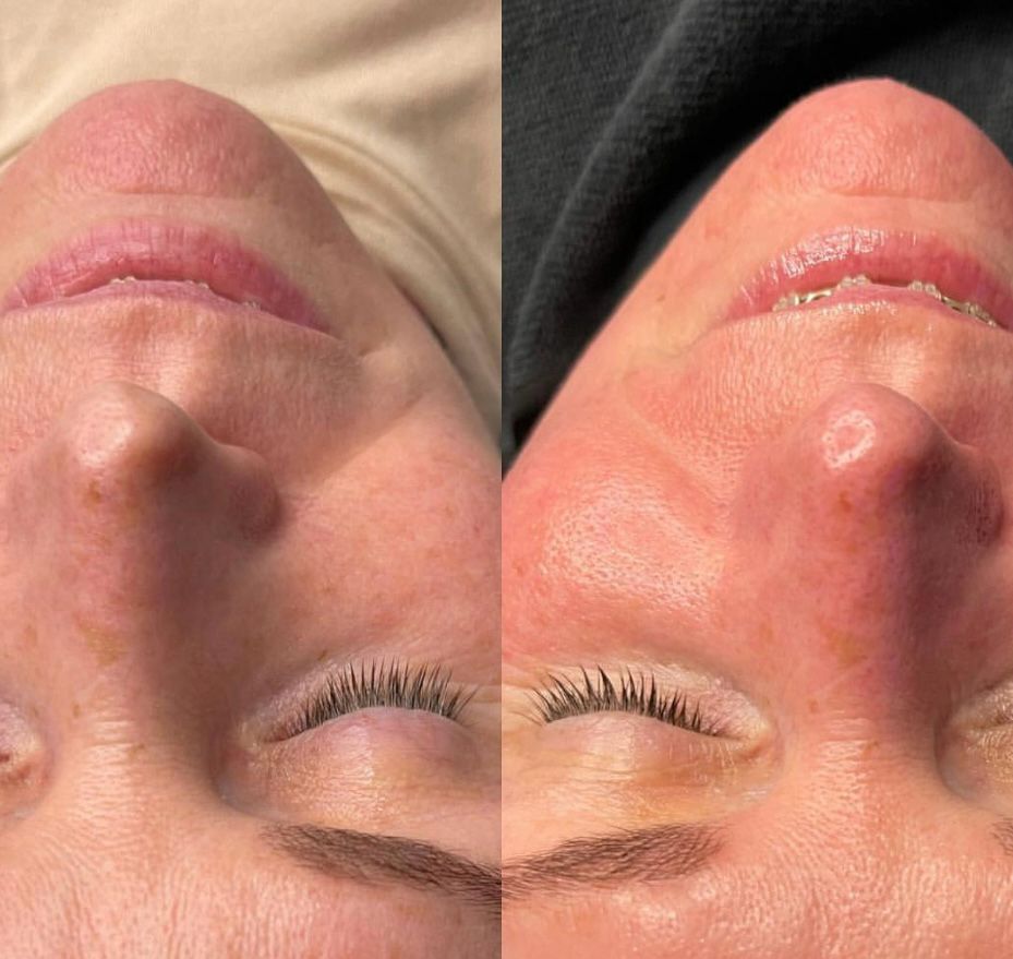 Advanced Hydrafacial